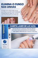 Tratamento para Unhas Remoção de Fungos nas Unhas - Caneta a Laser para Reparação das Unhas com Fungos - Indolor