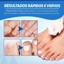 Tratamento para Unhas Remoção de Fungos nas Unhas - Caneta a Laser para Reparação das Unhas com Fungos - Indolor