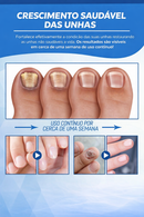 Tratamento para Unhas Remoção de Fungos nas Unhas - Caneta a Laser para Reparação das Unhas com Fungos - Indolor