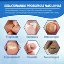 Tratamento para Unhas Remoção de Fungos nas Unhas - Caneta a Laser para Reparação das Unhas com Fungos - Indolor
