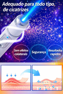 Dê Adeus à Cicatrizes - ScarRemoved Sistema a Laser na Segunda geração Elaborado para Solucionar Manchas e Cicatrizes na pele
