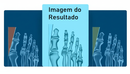 Joanete - Corretor ortopédico para joanete - Alivio da dor e Correção e Alinhamento do dedão sem Cirurgia