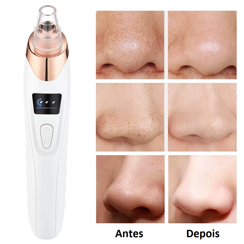 Removedor de Cravos e Peles Mortas VacuumUp - Aparelho aspirador removedor de peles mortas e cravos