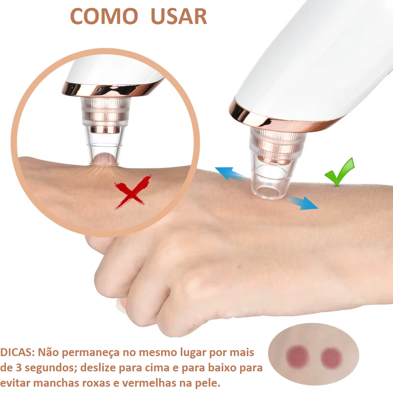 Removedor de Cravos e Peles Mortas VacuumUp - Aparelho aspirador removedor de peles mortas e cravos